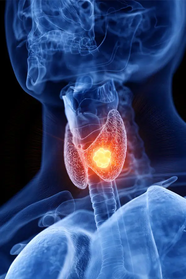 Thyroid-Imbalance-Treatment A 3D illustration of an x-ray of a human neck, highlighting the thyroid. Get help with thyroid imbalance from Julie Kane, NP of Bird Island Wellness in Calgary.